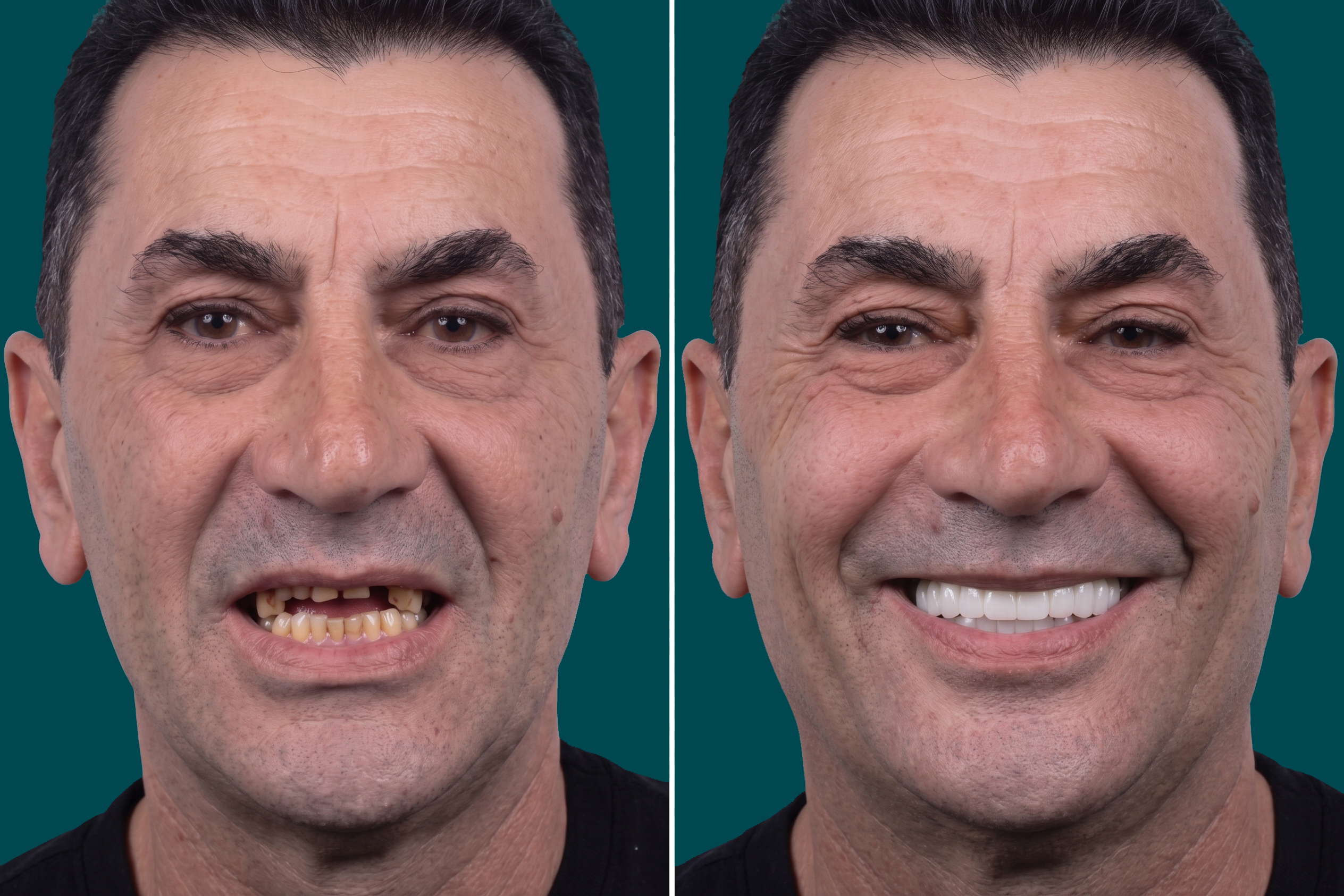 Dental Implants-Zygomatic Implants