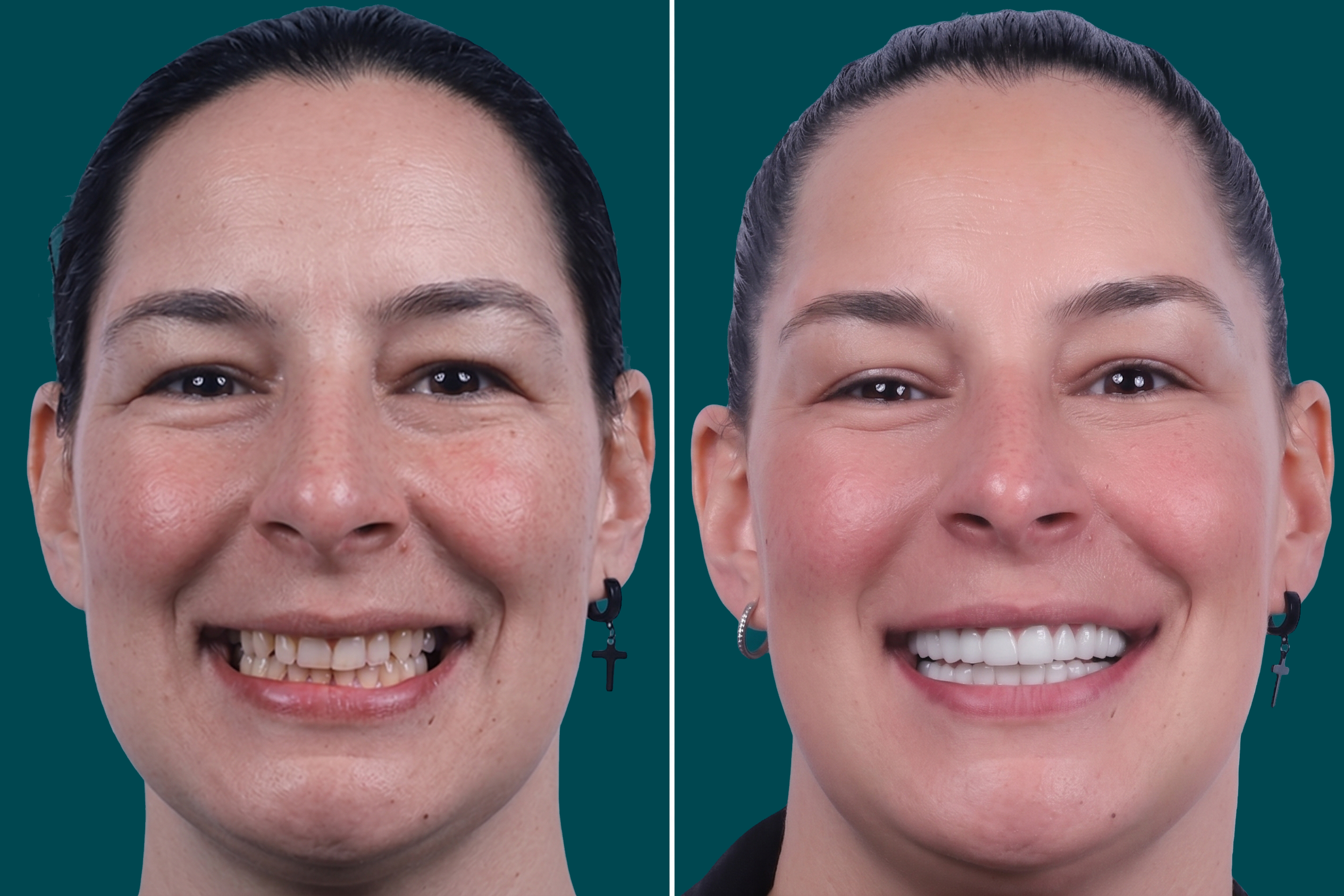 Dental Veneers 7