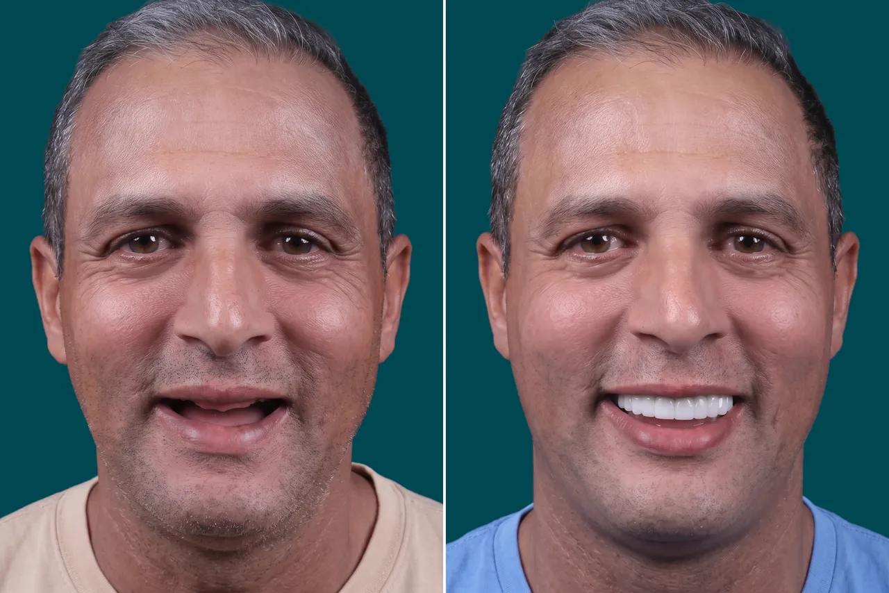 Dental Implants-Zygomatic Implants 3