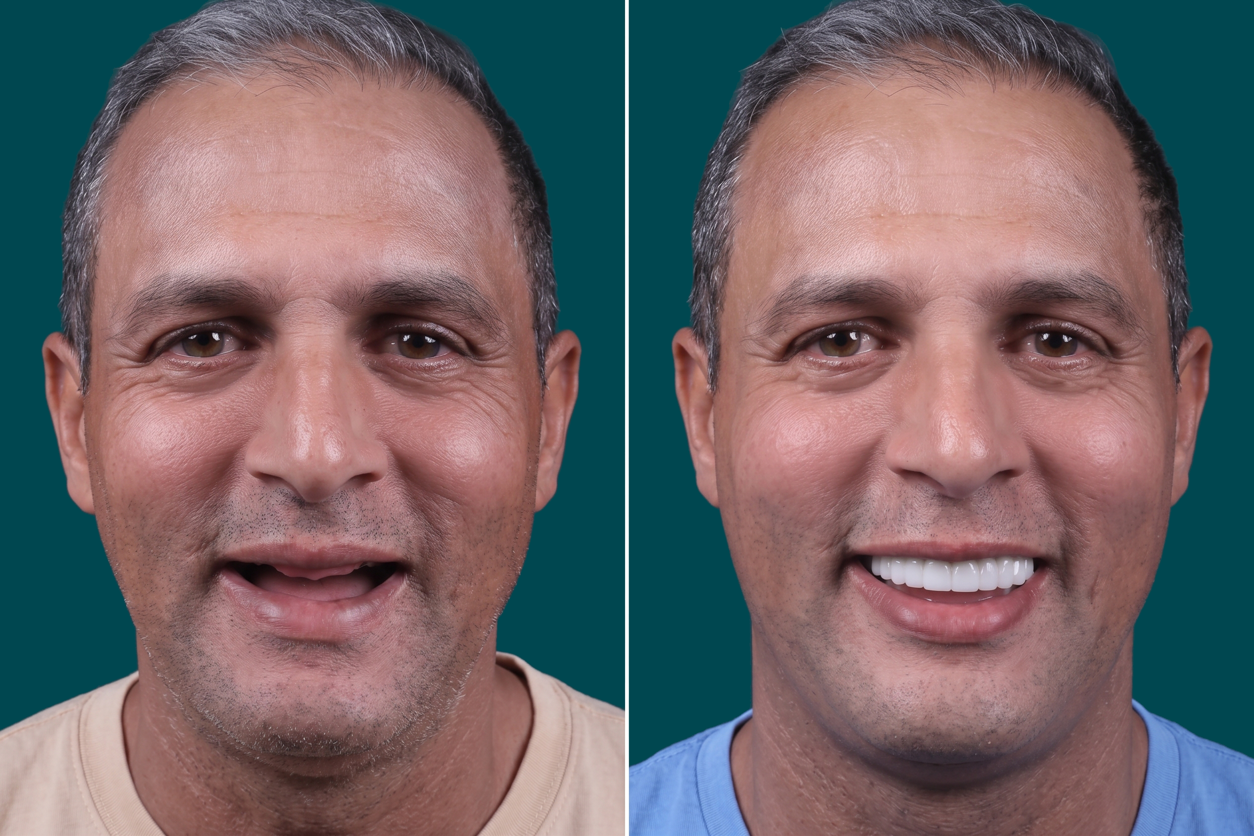 Dental Implants-Zygomatic Implants 3