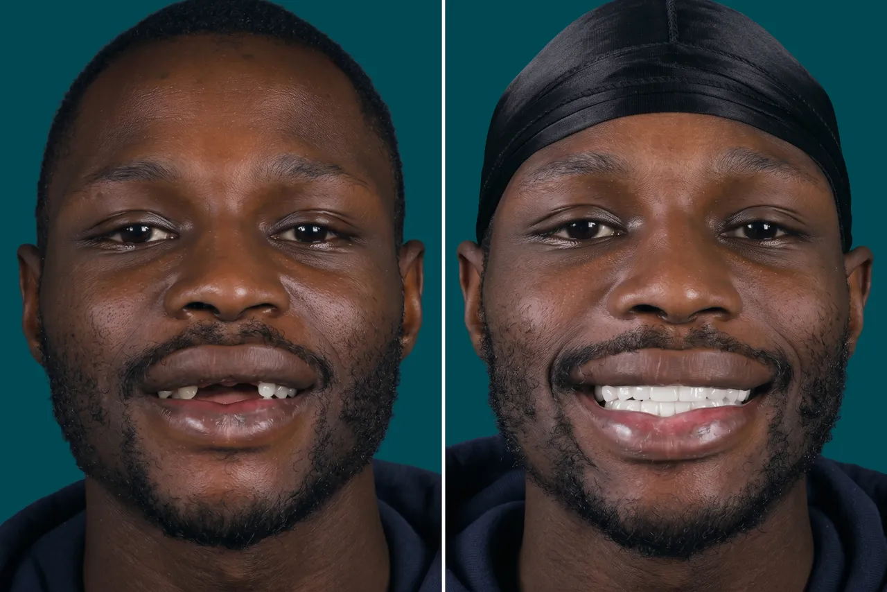 Dental Implants-Zygomatic Implants 2