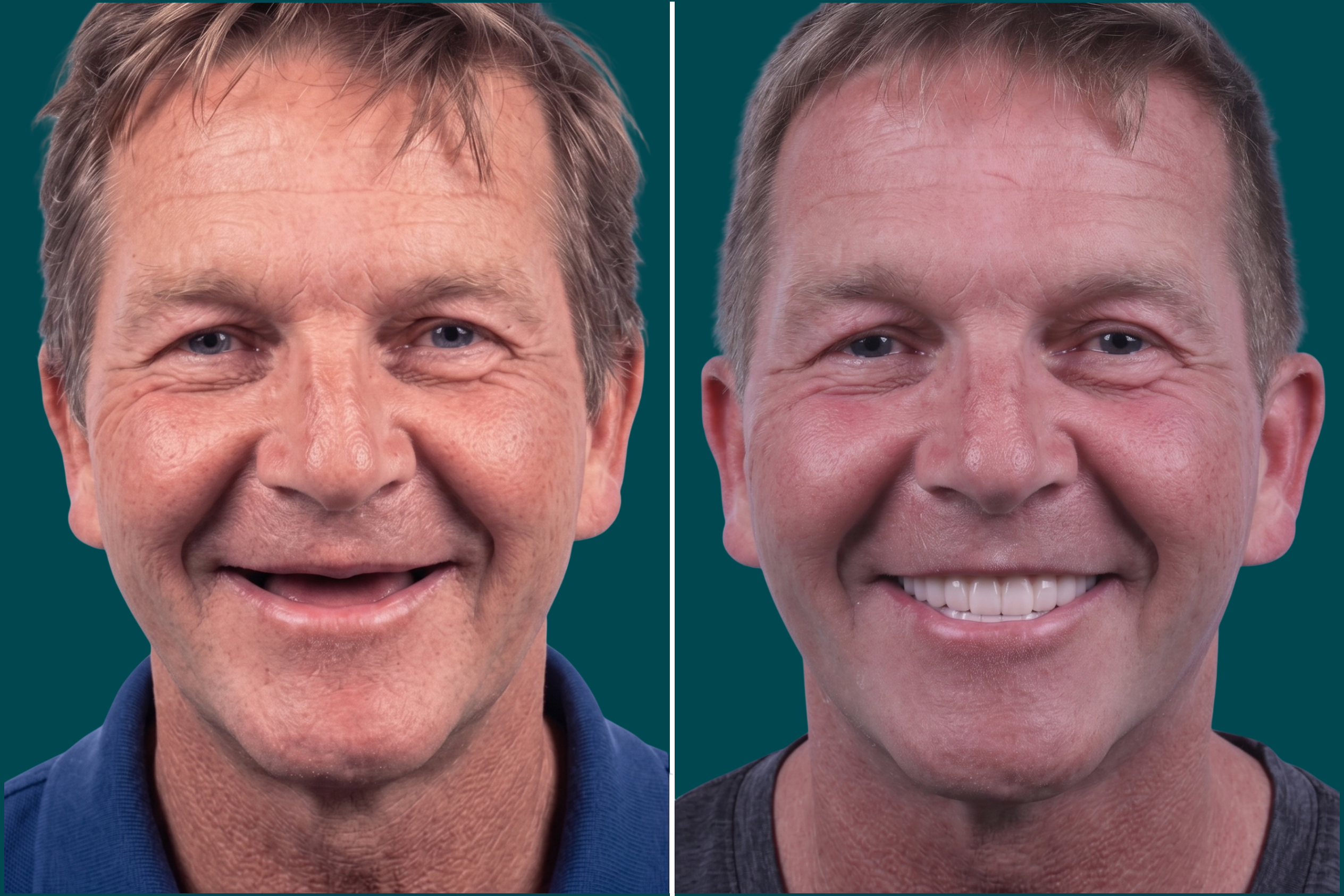 Dental Implants-Zygomatic Implants (1)