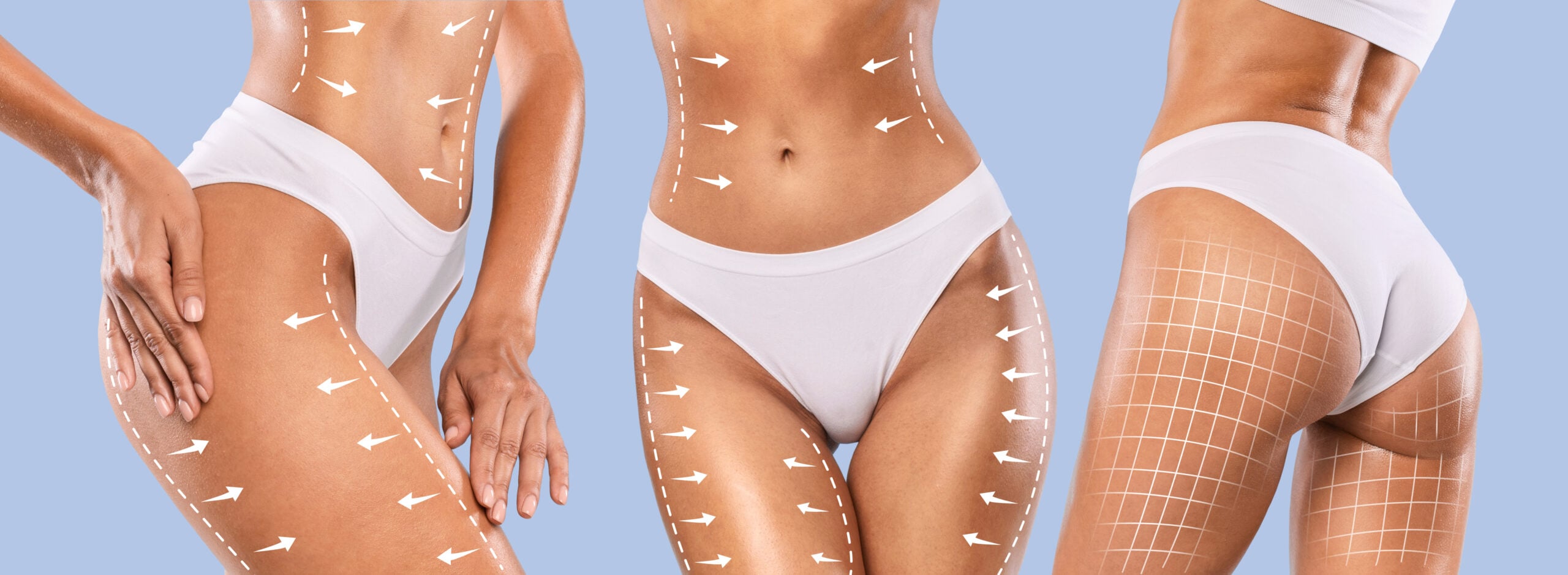 BBL before and after results showing body contouring and fat transfer to buttocks