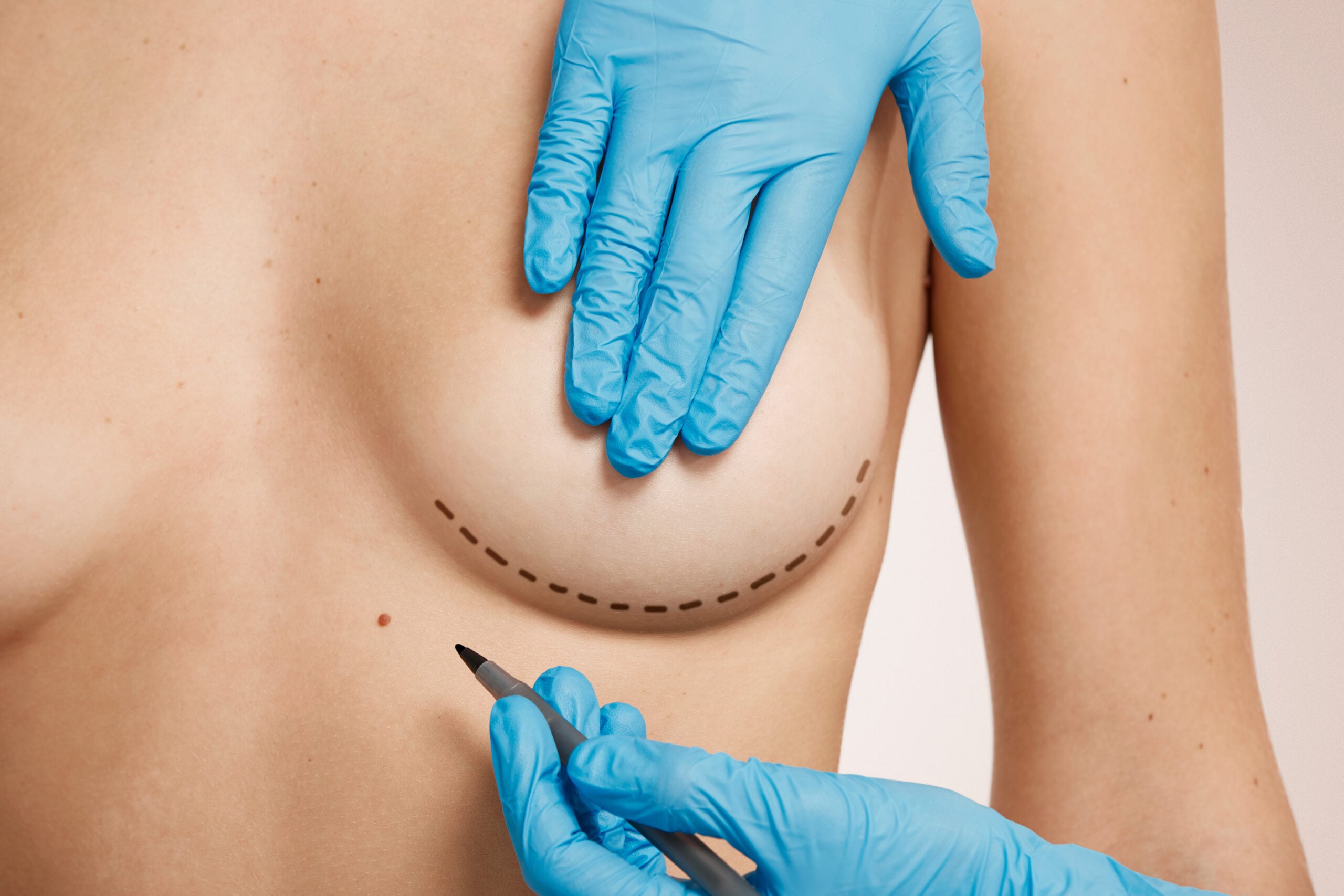 Natural-looking breast implant results by expert surgeons in Turkey