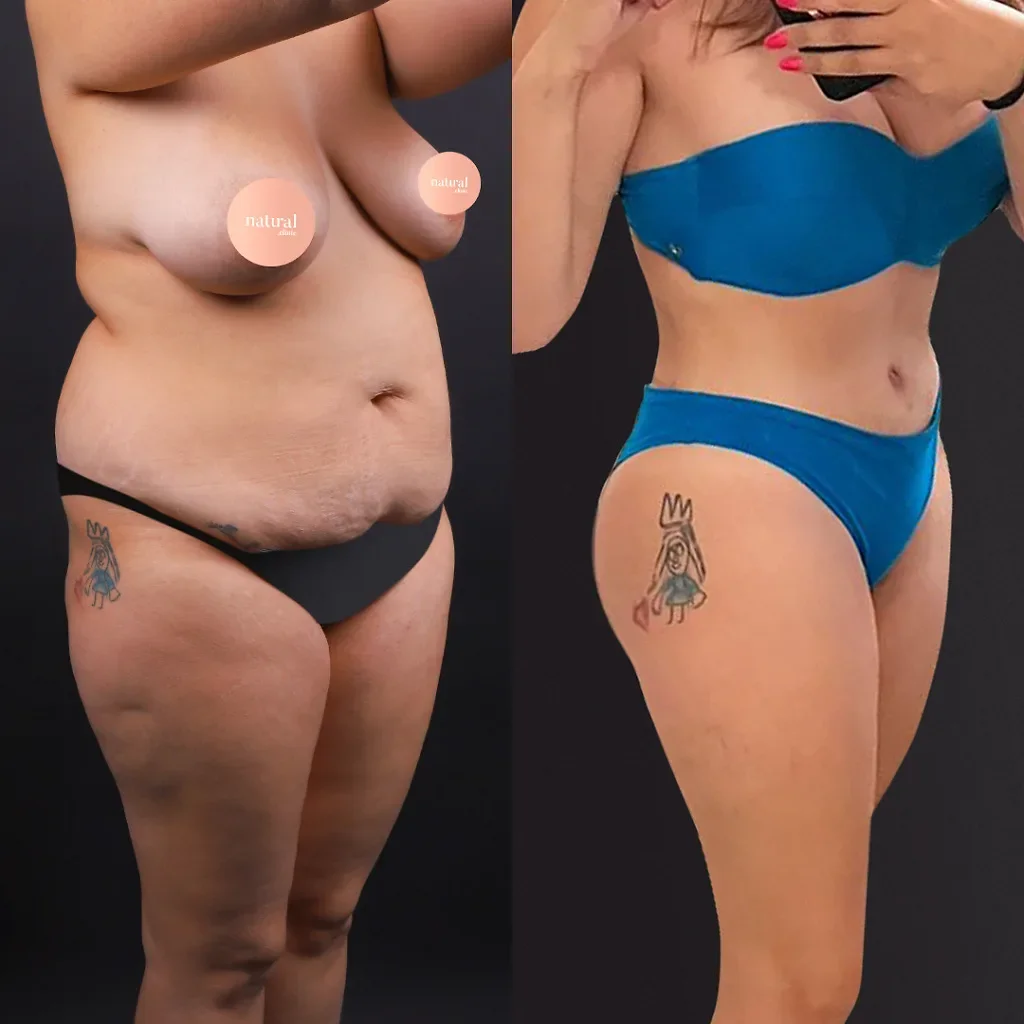 Risultato prima e dopo del Mommy Makeover 10