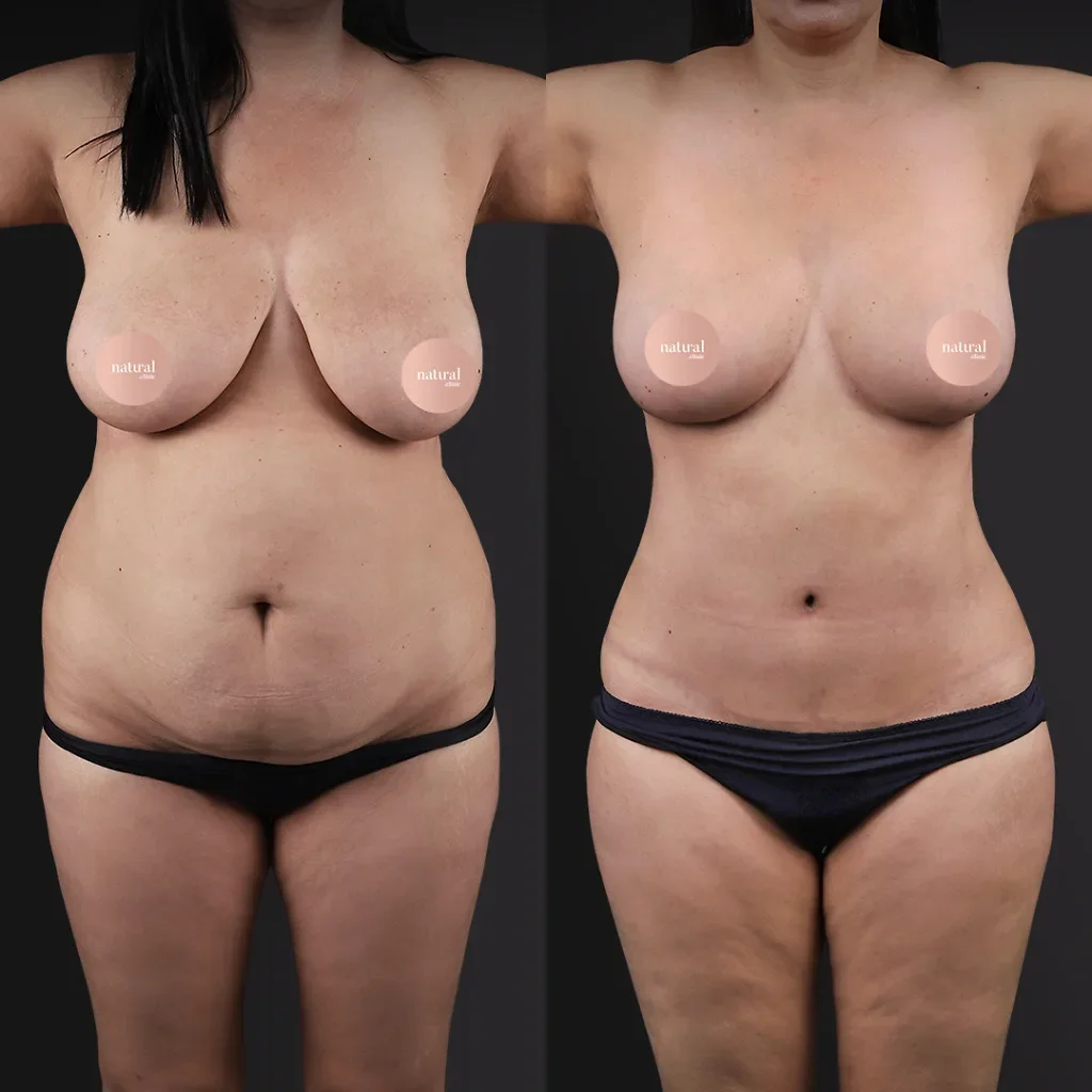 Risultato prima e dopo del Mommy Makeover 3