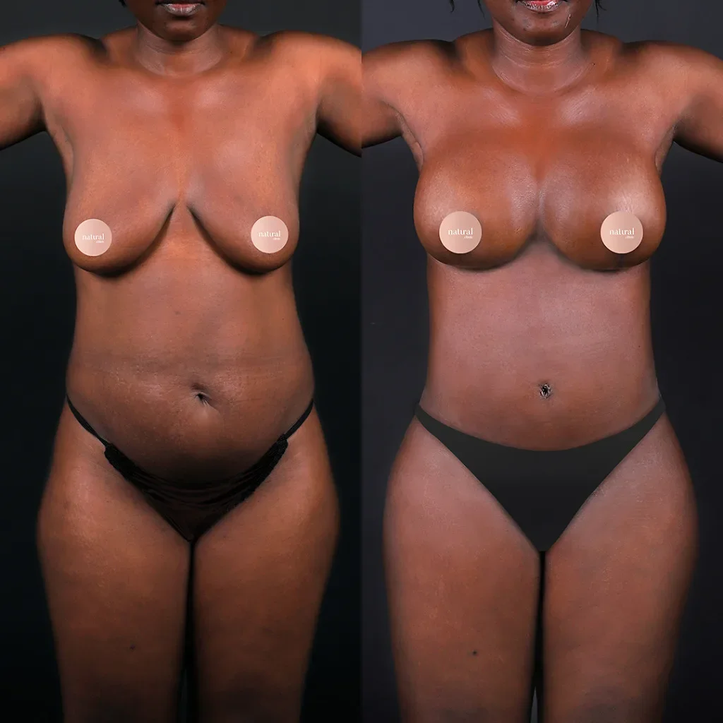 Risultato prima e dopo del Mommy Makeover 6