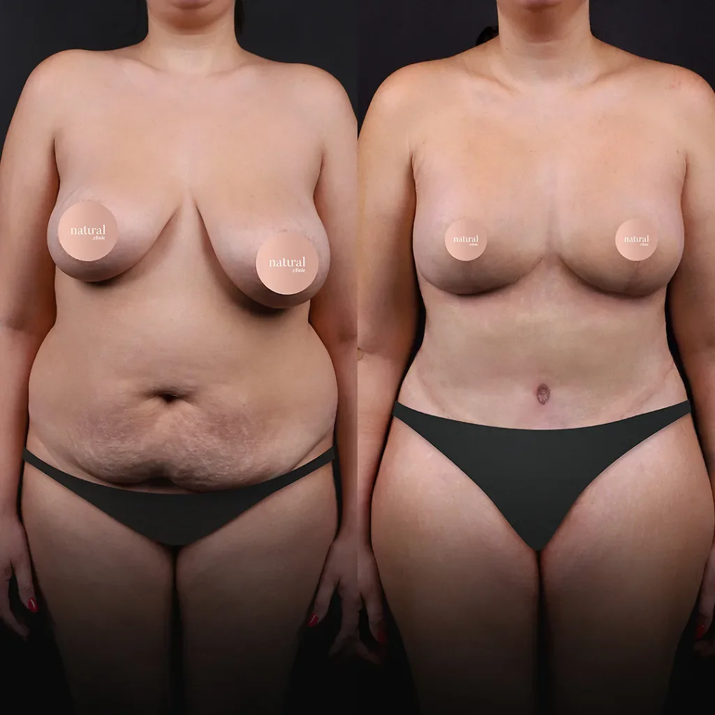 Risultato prima e dopo del Mommy Makeover 8
