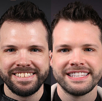 hollywood smile operation