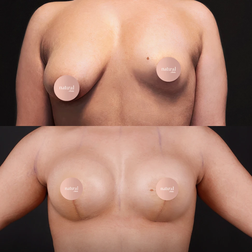 Breast Augmentation a55