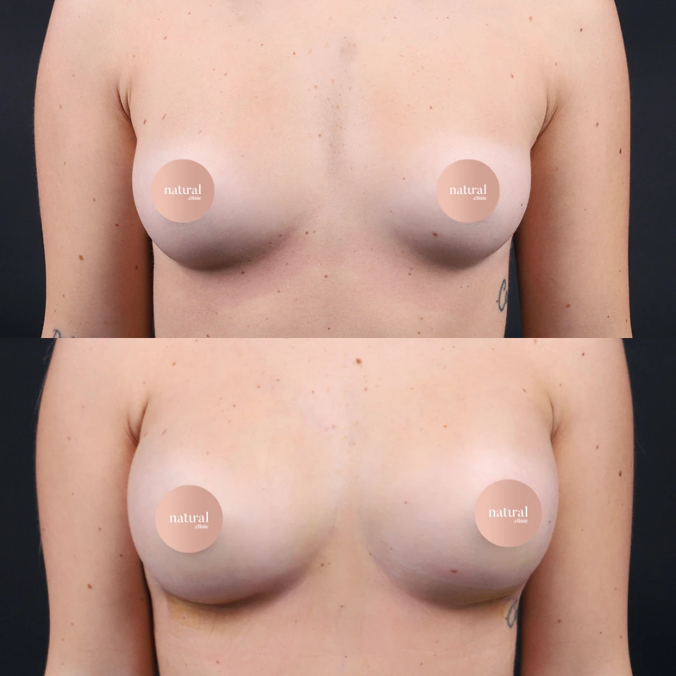 Breast Augmentation c1 1