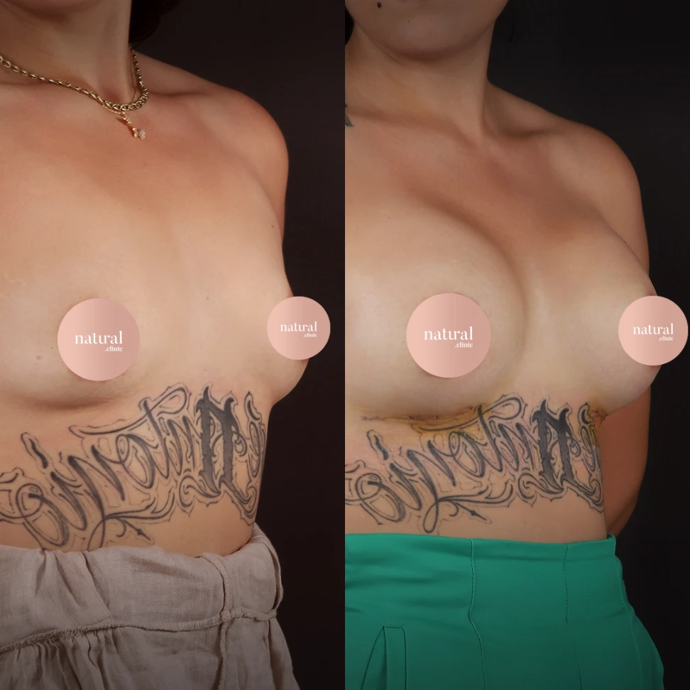 Breast Augmentation c12 2
