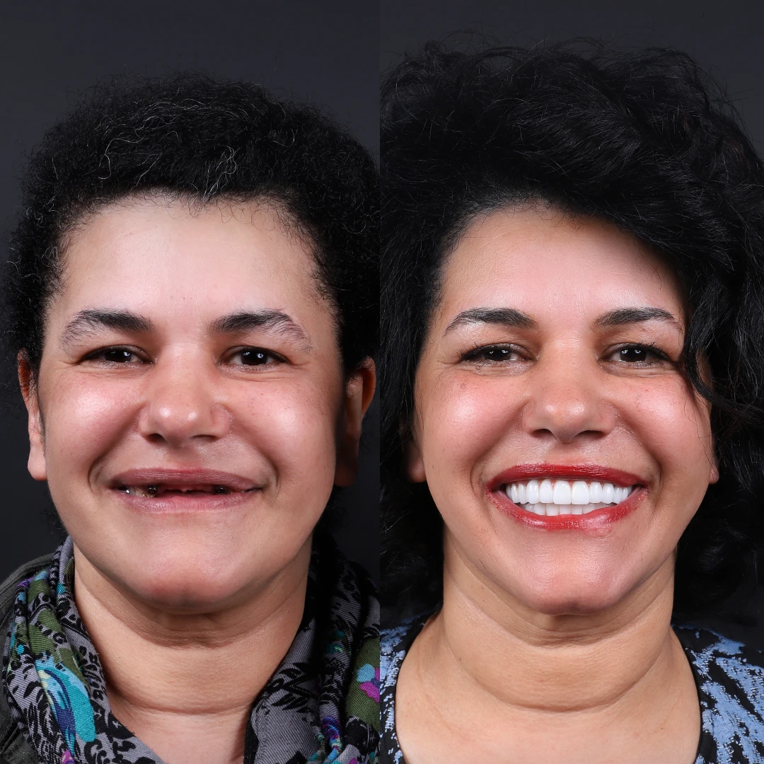 hollywood smile before after 2