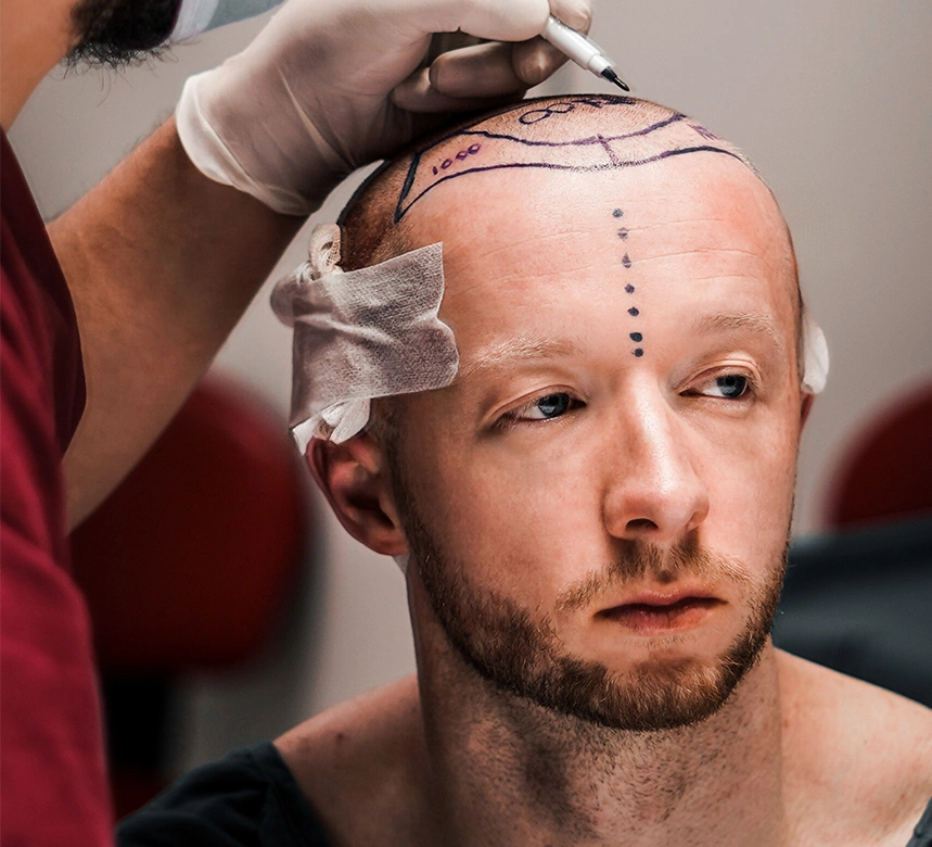 An Overview of Hair Transplantation