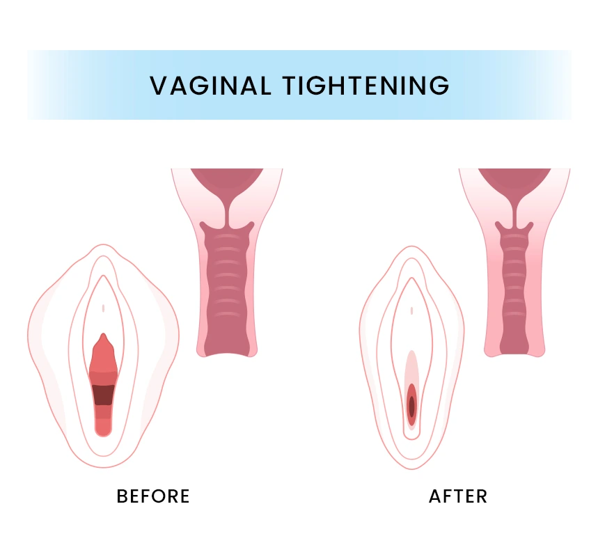 An Overview of Vaginal Tightening