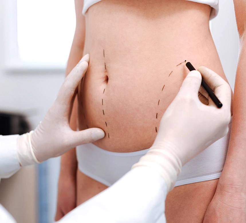 An Overview of Vaser Liposuction