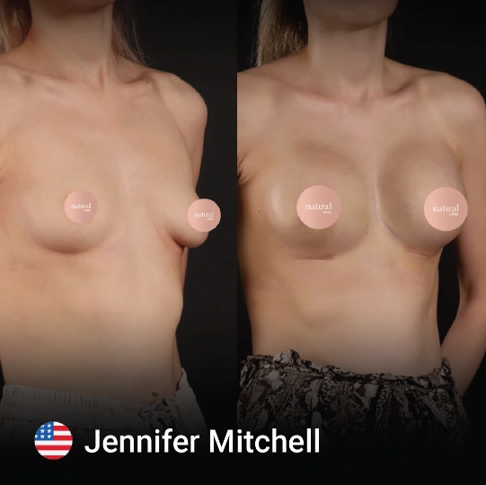 Breast Augmentation before and after 10