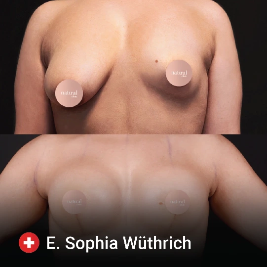 Breast Augmentation before and after 2
