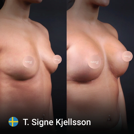 Breast Augmentation before and after 5