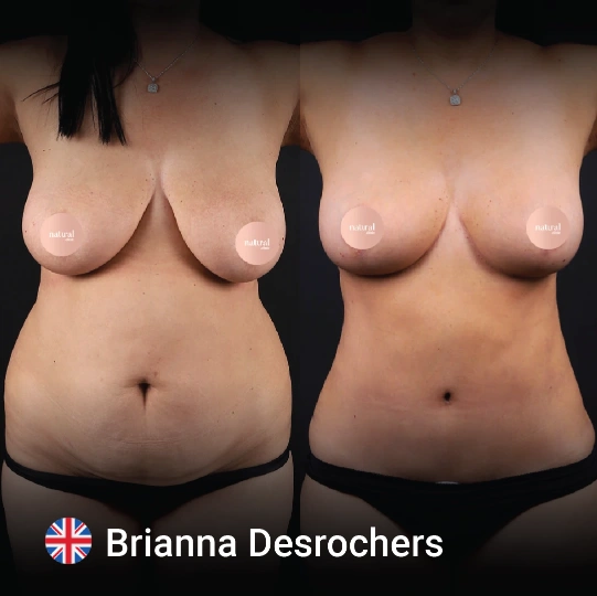 Breast Lifting before and after 2