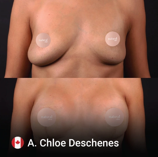 Breast Lifting before and after 4
