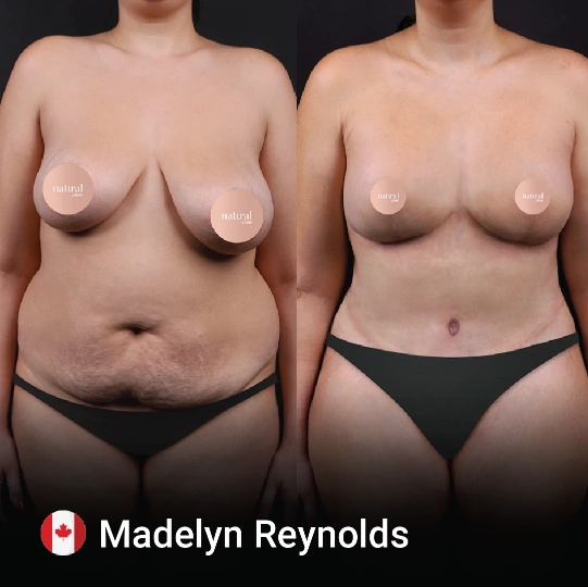 Breast Lifting before and after 5