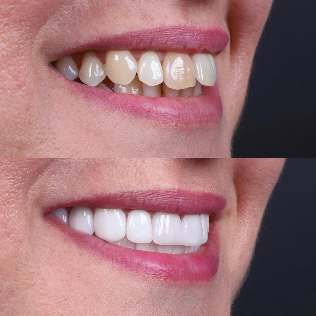 Before and after images of dental crowns fixing worn teeth for a rejuvenated and youthful appearance