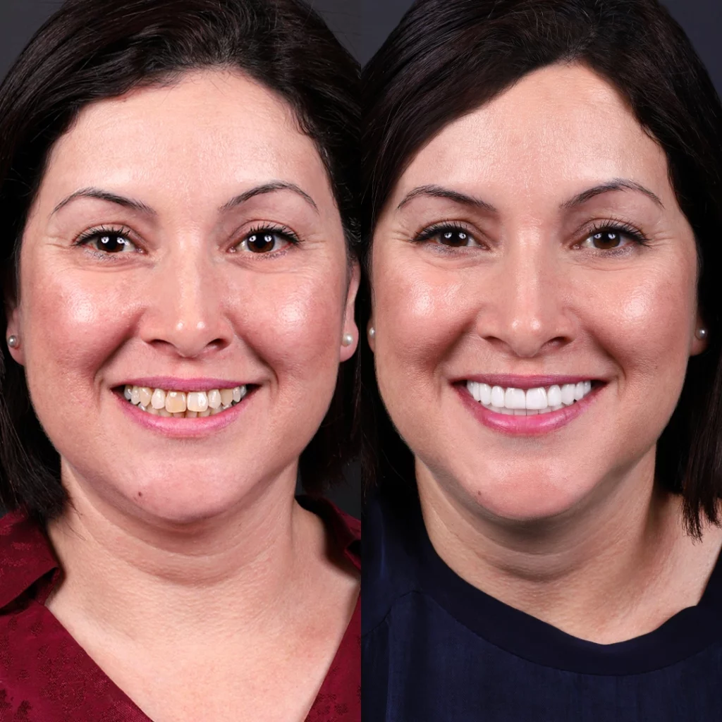 Before and after photos of dental crown treatment for chipped teeth, creating a smooth, polished finish