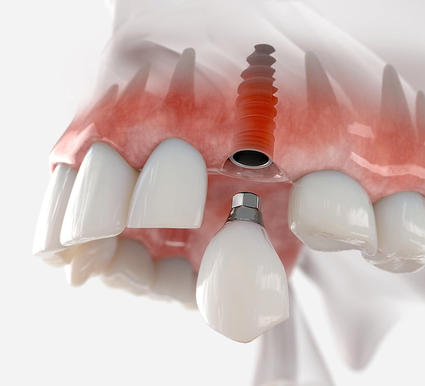Dental Implant 2