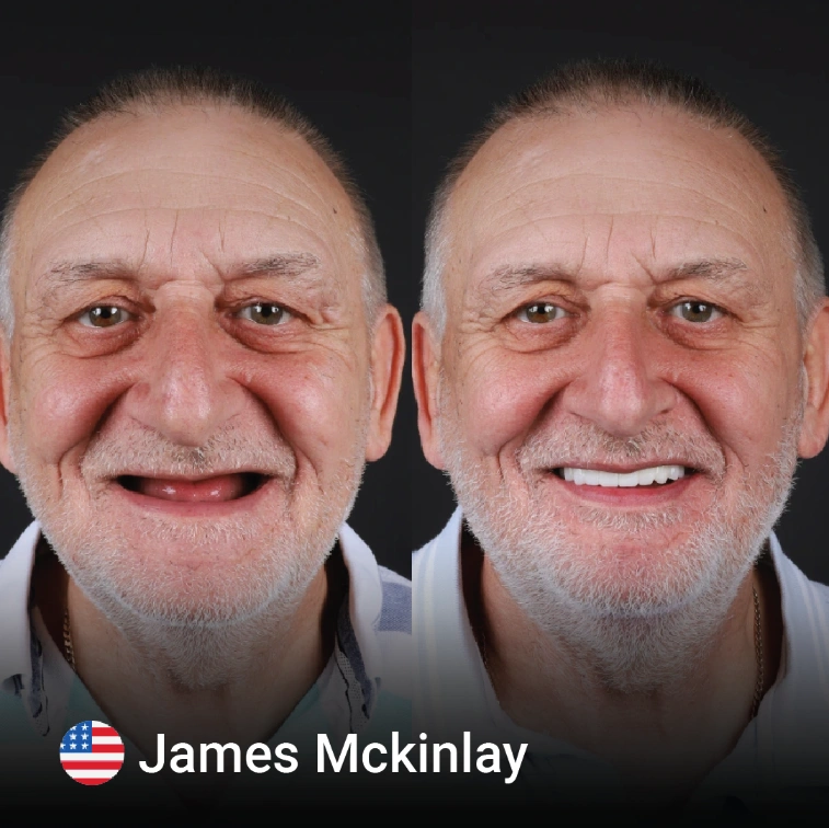 Dental Implant Before and after 2