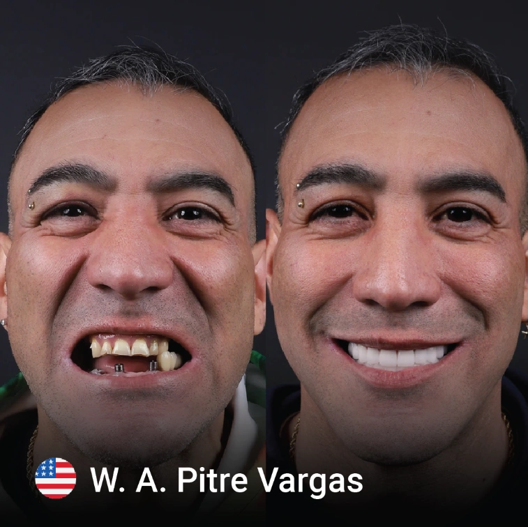 Dental Implant Before and after 8