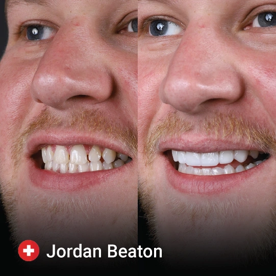 Dental Veneer before and after 2