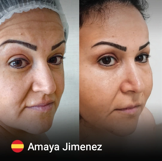 Face Fat Injection before and after 2