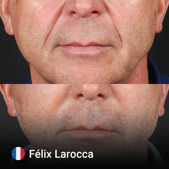 Face Fat Injection before and after 3
