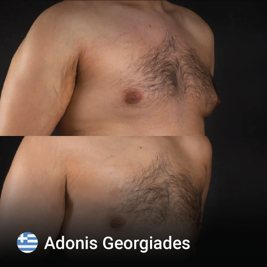 Gynecomastia before and after 1
