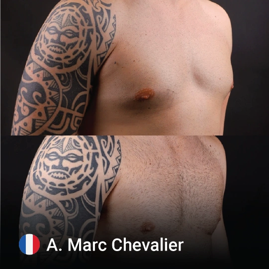 Gynecomastia before and after 2