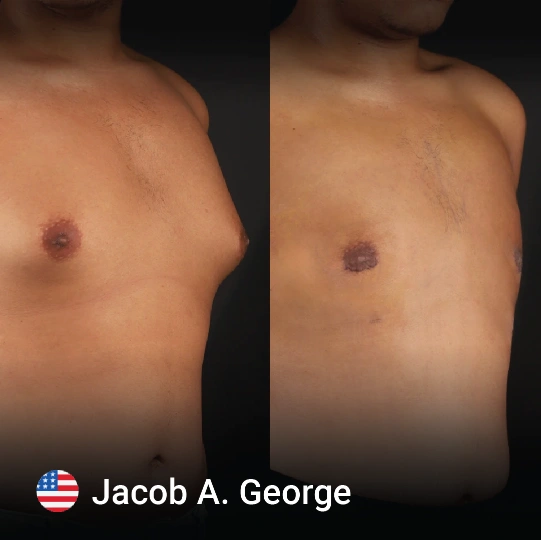 Gynecomastia before and after 3