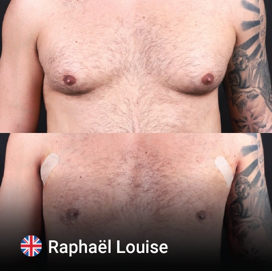 Gynecomastia before and after 4