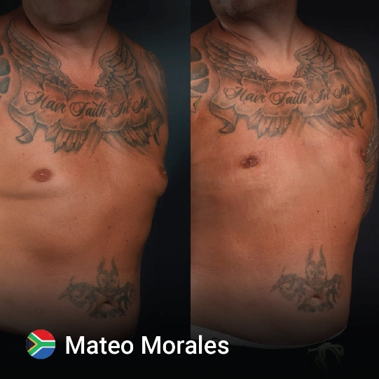 Gynecomastia before and after 5