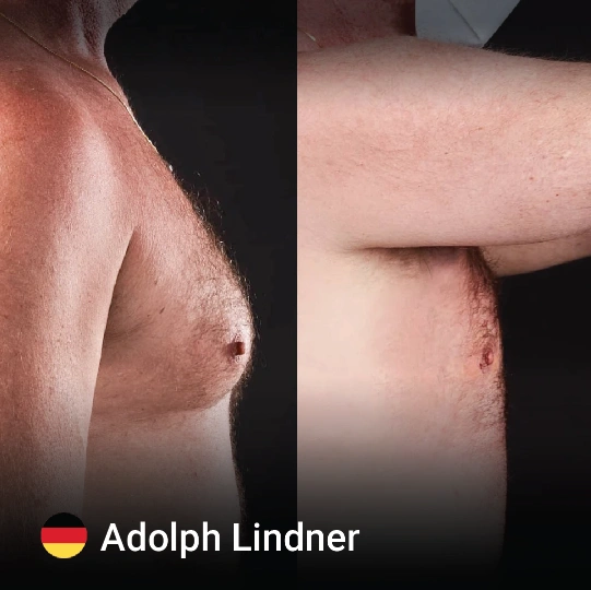 Gynecomastia before and after 6