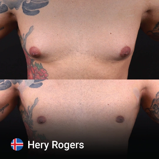 Gynecomastia before and after 8