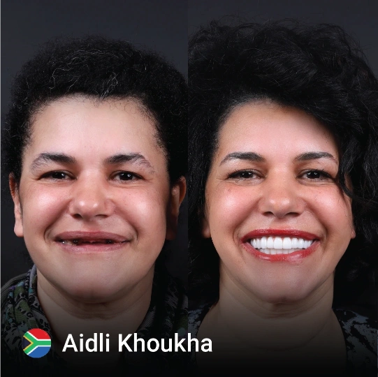 Hollywood smile before after 10 1
