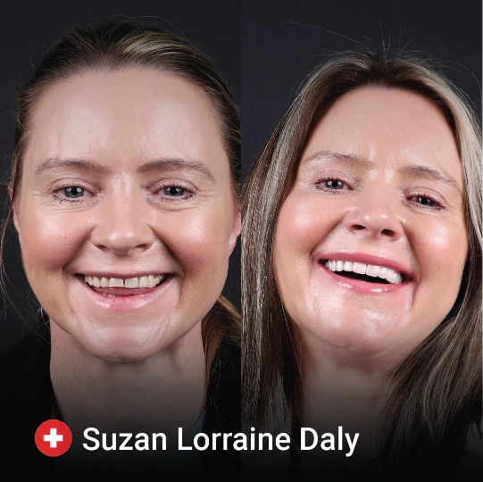 Hollywood smile before after 3 1