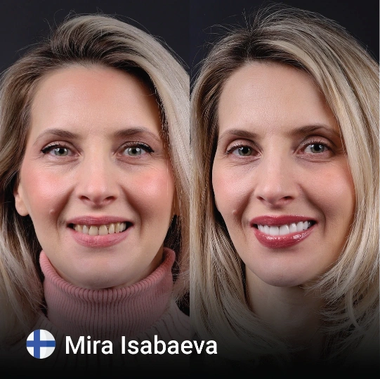 Hollywood smile before after 6 1