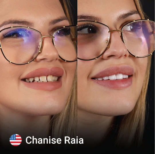 Hollywood smile before after 9 1
