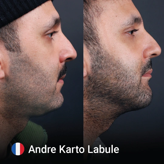 Neck Lift before and after 1