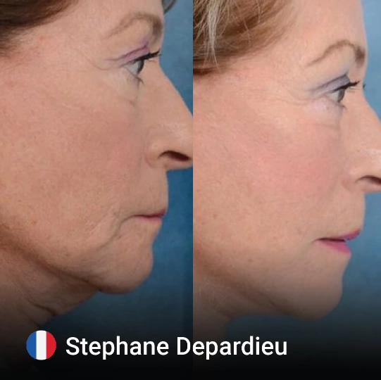 Neck Lift before and after 3