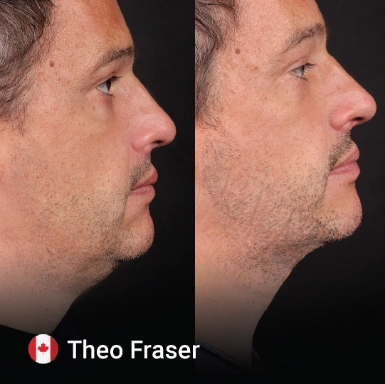 Neck Lift before and after 4