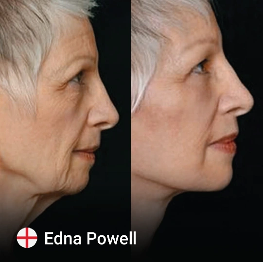 Neck Lift before and after 5