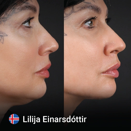 Neck Lift before and after 6